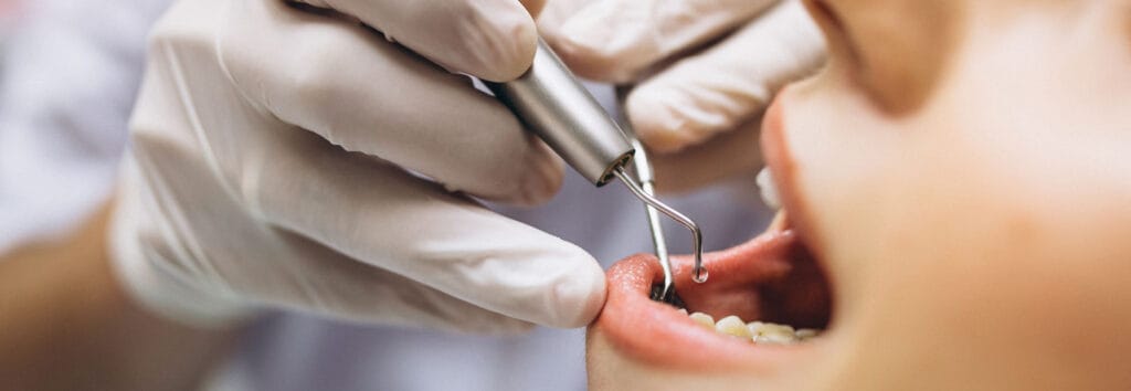 20 Yaş Diş Çekimi Softdent diş kliniğinde 20'lik diş çekimi işlemi görseli