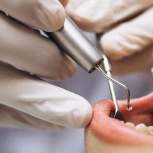 Softdent diş kliniğinde 20'lik diş çekimi işlemi görseli