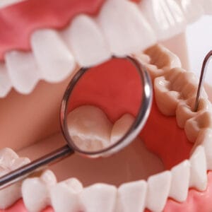 Diş Taşı Temizliği