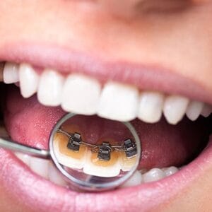 lingual görünmez tel tedavisi