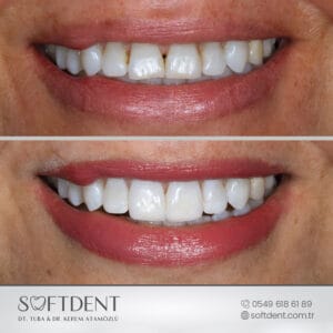 gülüş tasarımı lamine kaplama öncesi ve sonrası hasta deneyimi