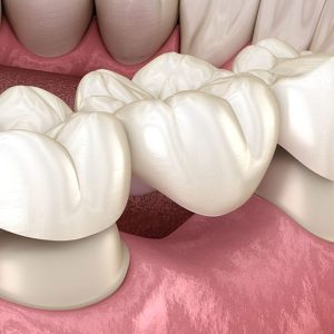 Köprü diş tedavisi örneği. bilgisayar ortamında simüle edilmiş versiyon