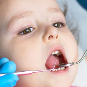 Kadıköy Diş Kliniği - Süt Dişi Kanal Tedavisi Örneği