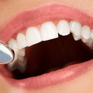 zirkonyum-kaplama Zirkonyum diş kaplama tedavisi gerçekleşmiş temsili bir örnek