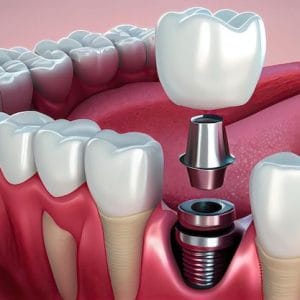 2026 implant fiyatlarını temsil eden implant işleminin çizim görseli