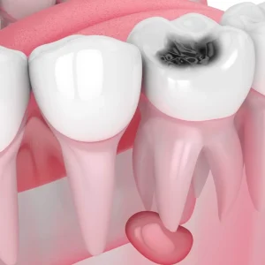 dis-kisti-nedir-dis-kisti-nasil-tedavi-edilir Kist Operasyonu