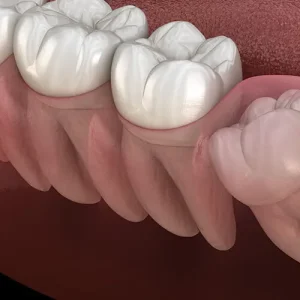 gomulu-dis-tedavisi 20'lik gömülü diş sıkıştırması