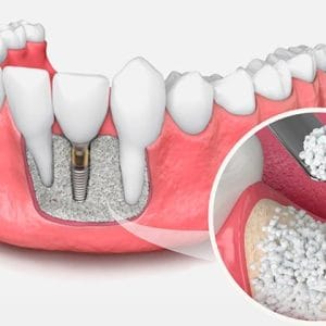 bone grafting_article images - blyss-dental-bone-graft-hero imag Greft Operasyonları