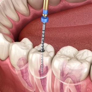 Kanal tedavisi örnek görsel