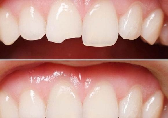 Kırık Diş Tedavisi