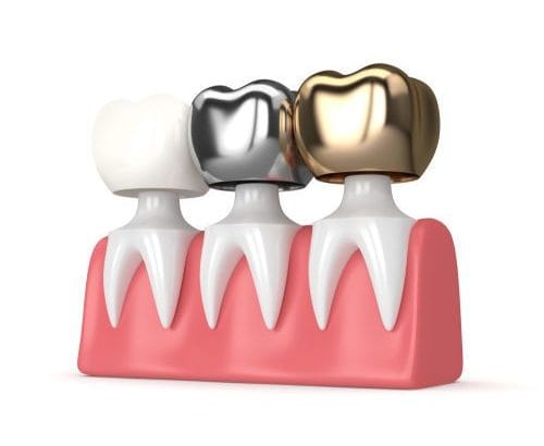 Kuron tedavisini çizim olarak anlatan beyaz arka plana sahip kuron kaplamalar