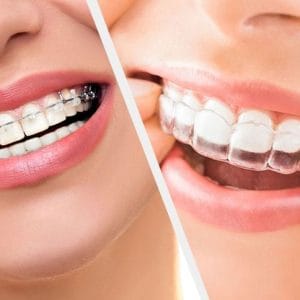 Diş teli ve Şeffaf plak tedavi örnekleri