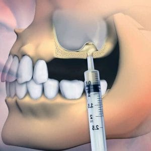 sinüs-lifting-tedavisi Sinüs Lifting Tedavisi