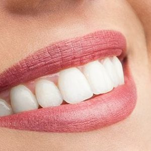 Gülüş tasarımı lamine diş kaplama