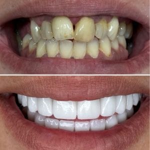 Diş Kaplama Fiyatları (Güncel) – Diş Kaplama Fiyat Listesi