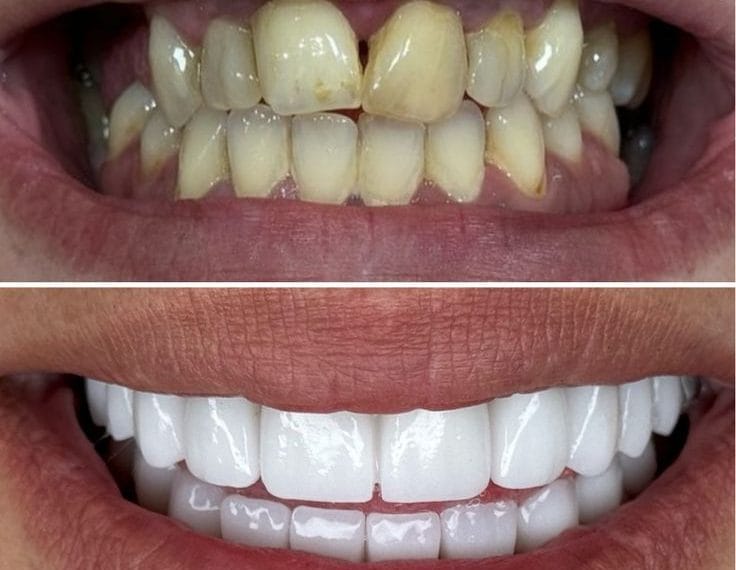 Diş Kaplama Fiyatları (Güncel) – Diş Kaplama Fiyat Listesi