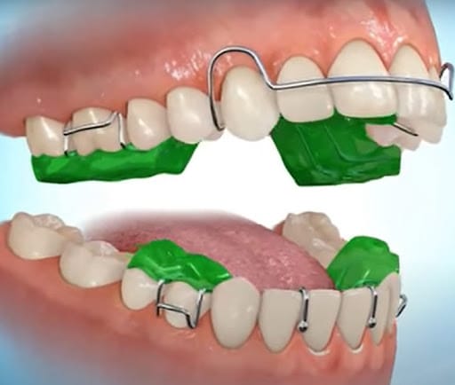 Alt Çene Geriliği Aparatı Twin block çene aparatının 3d modellenmiş hali