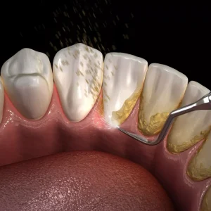 Diş taşı temizliği işlemi ve sonrasında yapılması gereken durumlar